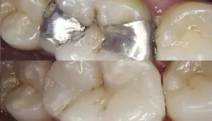 White Dental Fillings