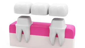 Dental Bridges Chelmsford