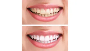 Teeth Whitening