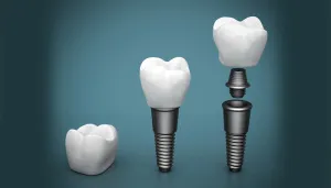 Dental Implant