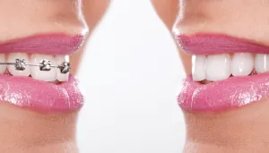 Teeth Straightening Chelmsford